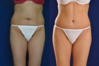 Abdominoplasty with Vaser Hi Def Liposuction of back and flanks with fat transfer to buttocks