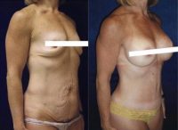 55-64 year old woman treated with Mommy Makeover