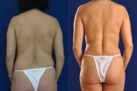 Vaser Hi Def Liposuction of chest, abdomen, back and flanks