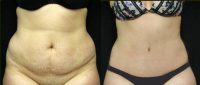 Extended Tummy Tuck with Liposuction of Abdomen, Flanks and Low Back.