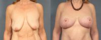 Patient 9 Breast Lift with Silicone Gel Breast Implants