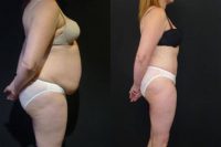 Tummy Tuck and Liposuction