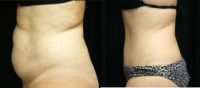 Drainless Tummy Tuck with Liposuction-4 Months Post-Op