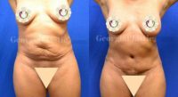 Woman treated with Tummy Tuck