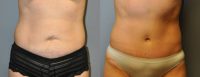 Abdominoplasty - 45 year old female, 2 months post-op