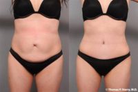 36 year old woman treated with Liposuction