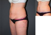 Natural, Slimming Results with a Low-Scar Tumy Tuck
