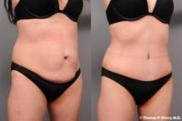 36 year old woman treated with Tummy Tuck