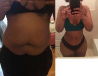 25-34 year old woman treated with Tummy Tuck, liposuction and BBL