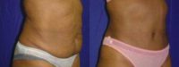 51-55 year old woman treated with Tummy Tuck