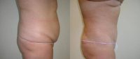 Patient treated with Tummy Tuck