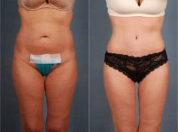 25-34 year old woman treated with Tummy Tuck