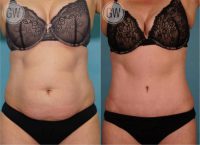 35-44 year old woman treated with Tummy Tuck + Circumferential Liposuction