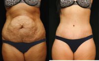 Drainless Tummy Tuck to Remove Stretch Marks