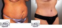 Dramatic Transformation with a Low Scar Tummy Tuck and Liposuction
