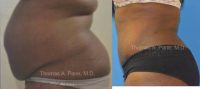 35-44 year old woman treated with Tummy Tuck