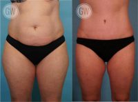 35-44 year old woman treated with Liposculpture