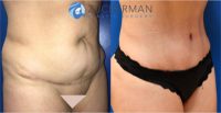 25-34 year old woman treated with Tummy Tuck