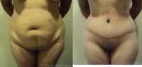 52 year old female treated for abdominoplasty
