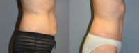 Abdominoplasty - 45 year old female, 2 months post-op