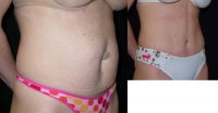 Abdominoplasty and liposuction with an umbilical hernia repair.