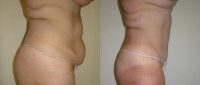 Patient treated with Tummy Tuck