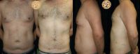 35-44 year old man treated with Male Tummy Tuck and liposuction
