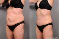 36 year old woman treated with Liposuction