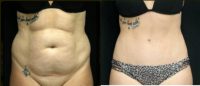 Drainless Tummy Tuck with Liposuction - 4 Months Post-Op