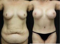 Mommy Makeover with Extended Tummy Tuck and 650cc Breast Augmentation