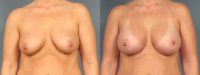 Patient 6 Breast Augmentation with 375 cc Cohesive Gel Breast Implants
