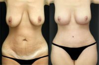Patient in her 40's had a Mommy Makeover-7 Weeks post-op