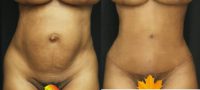 Tummy Tuck with Liposuction and Hernia Repair