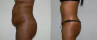 Tummy tuck and muscle tightening