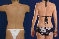 Vaser Hi Def Liposuction of chest, abdomen, back and flanks