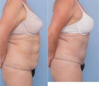 58 year old woman treated with Tummy Tuck