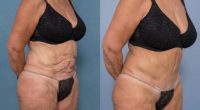 55-64 year old woman treated with Abdominoplasty and Ventral Hernia Repair