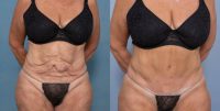55-64 year old woman treated with Abdominoplasty and Ventral Hernia Repair