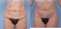 58 year old woman treated with tummy tuck & hip liposuction