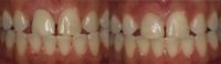 18-24 year old woman treated with Dental Crown