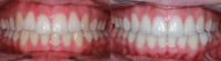 18-24 year old woman treated with Lingual Braces