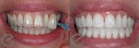 18-24 year old woman treated with Teeth Whitening