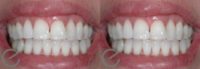 18-24 year old woman treated with Teeth Whitening