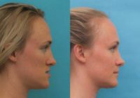 18-24 year old woman treated with Genioplasty