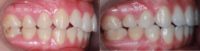 18-24 year old woman treated with Lingual Braces