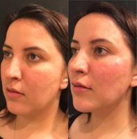 25-34 year old woman treated with Non Surgical Face Lift