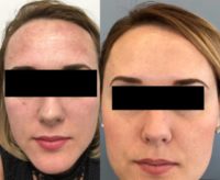 25-34 year old woman treated with IPL