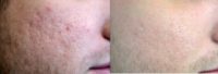 25-34 year old man with acne scars treated with ProFractional Laser
