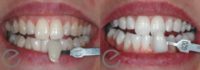 25-34 year old woman treated with Teeth Whitening