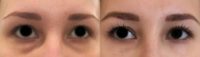 25-34 year old woman treated with Dermal Fillers for dark circles under eyes